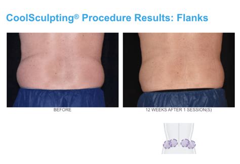 speed up coolsculpting results|CoolSculpting Fat Freezing Treatments, Side Effects & Results .